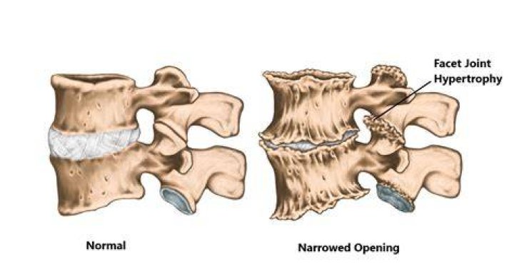 A Comprehensive Guide To Facet Hypertrophy: Definition And Causes