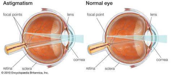 Astigmatism is when the cornea is slightly curved rather than