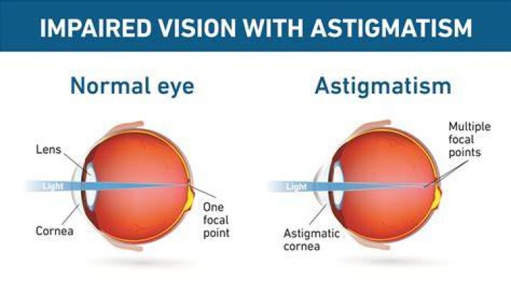 Famous How To Fix Astigmatism At Night Ideas