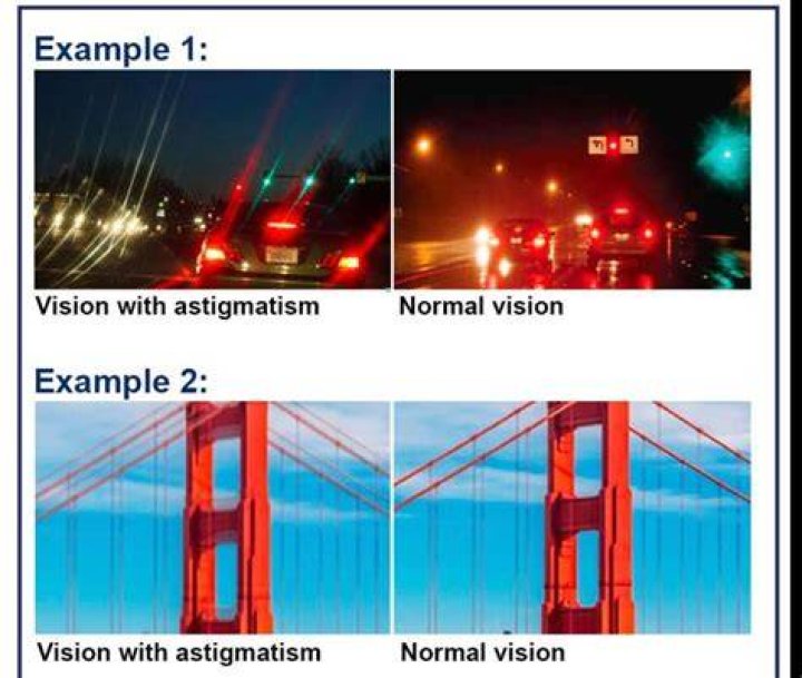 Living With Astigmatism (2022)