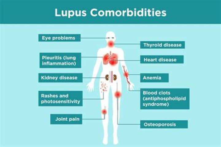 Understand Ozempic's Impact On Lupus: A Comprehensive Exploration