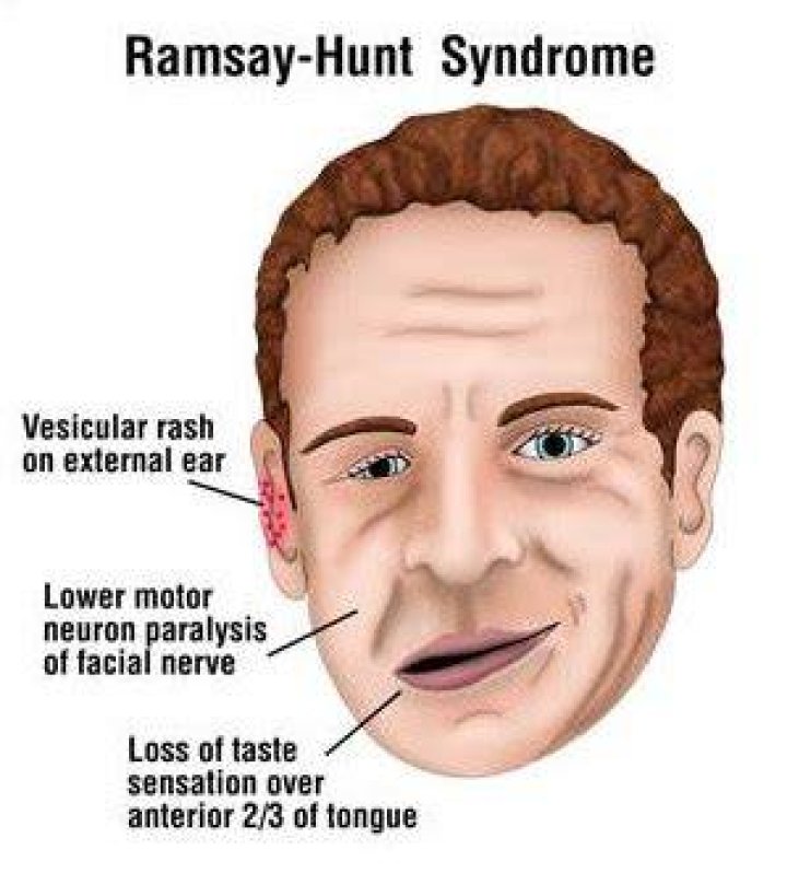 Understanding Ramsay Hunt Syndrome: Causes, Symptoms And Treatment